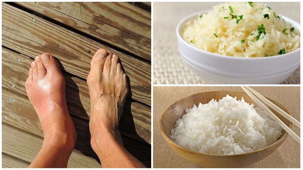 A rice-based diet is recommended for patients with gout. 